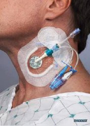 Sorbaview SHIELD Integrated Securement Dressing Fabric / Film 3-3/4 X 4-3/4 Inch Sterile, SV430UDT, Case of 50