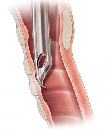 Flex-Tip Cuffed Endotracheal Tube Curved 4.0 mm Pediatric Murphy Eye, H-PFNC-40-5, Case of 5