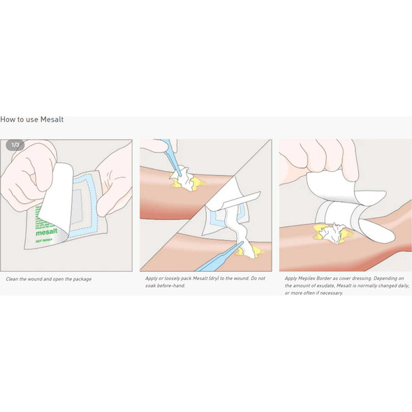 Impregnated Dressing Mesalt 6 X 6 Inch Viscose / Polyester Sodium Chloride Sterile 285780 Box/30 285780 MOLNLYCKE HEALTH CARE US LLC 400463_BX