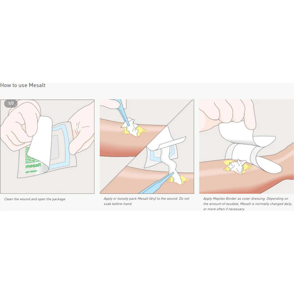 Sodium Chloride Impregnated Dressing Mesalt® Square 6 x 6 Inch / 3 x 3 Inch Folded Sterile 285780 Case of 240 285780 Mesalt® 400463_CS