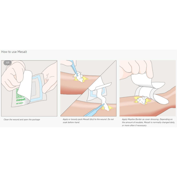 MESALT STRIP DRSG .75X39" 10/BX 8BX/CS MOLNLYCKE 285280 Each/1 MOLNLYCKE HEALTH CARE US LLC 1087157_EA
