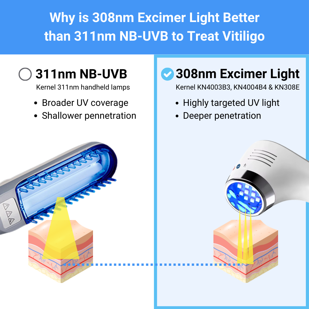 308nm Excimer LED PRO – Advanced UV Therapy for Vitiligo