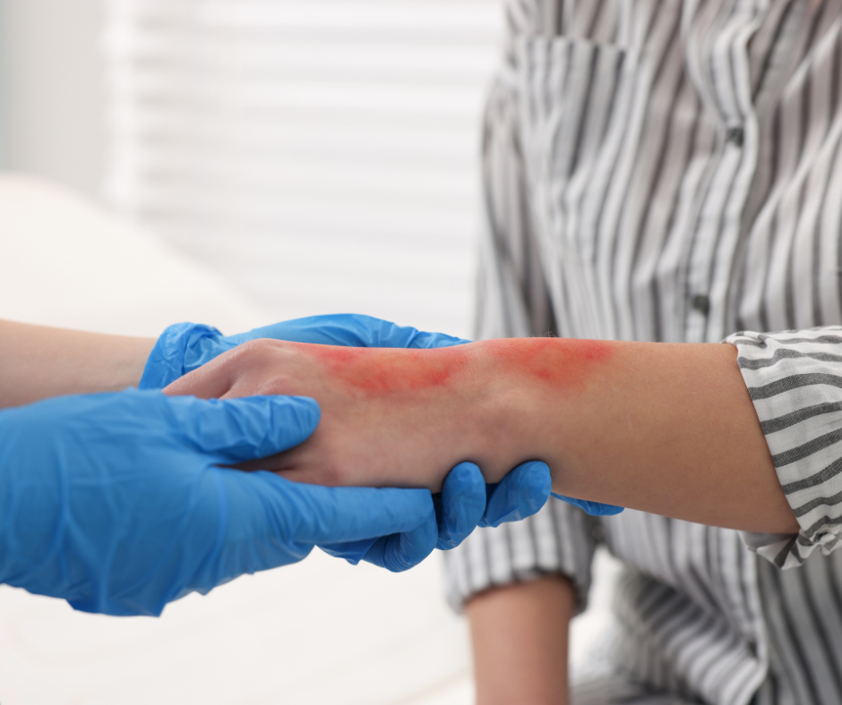 Burn Care Guide: Treating First, Second, and Third Degree Burns