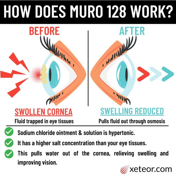 How Does Muro 128 Sodium Chloride Work to Reduce Corneal Edema after LASIK