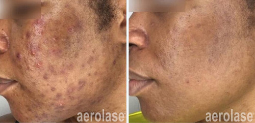 Laser Treatment for Acne at Vivrant Medspa