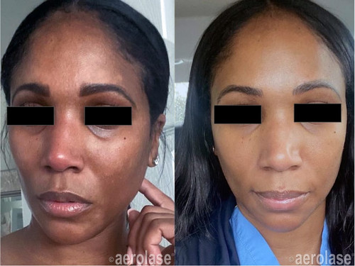 Laser Treatment for Melasma and Hyperpigmentation at Vivrant Medspa