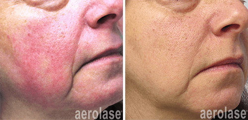 Laser Treatment for Rosacea, Redness and Eczema at Vivrant Medspa