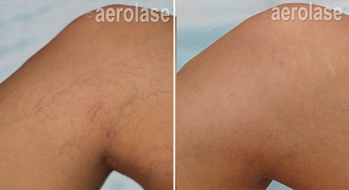 Laser Treatment for Spider Veins Before and After