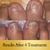 Laser Treatment for Nail (Toe) Fungus