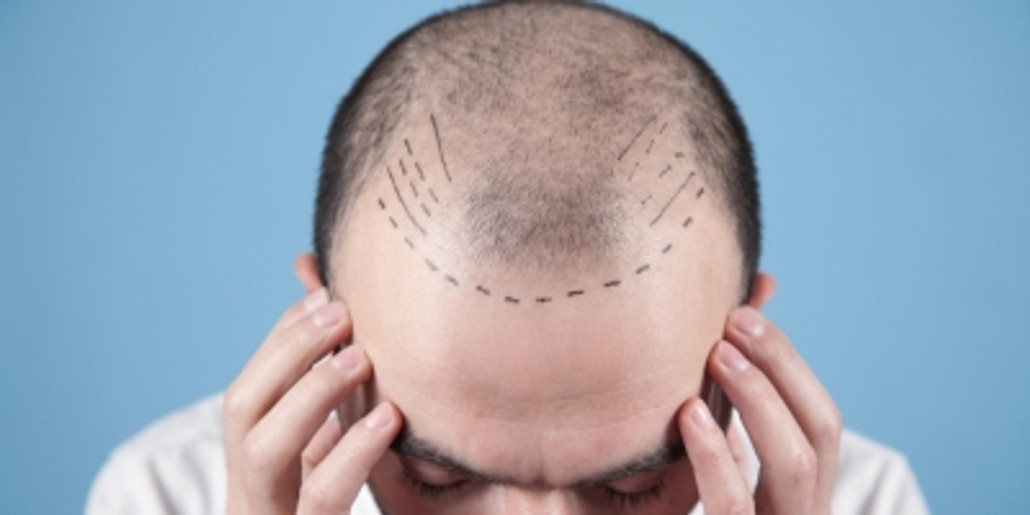 Faut-il subir une greffe de cheveux en Turquie?