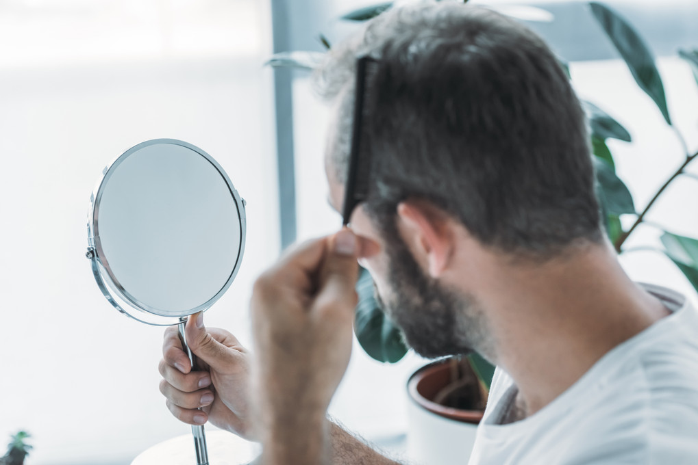 Les célébrités qui perdent leurs cheveux