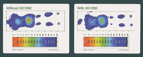 Pressure Mapping of XD Superior Overlay