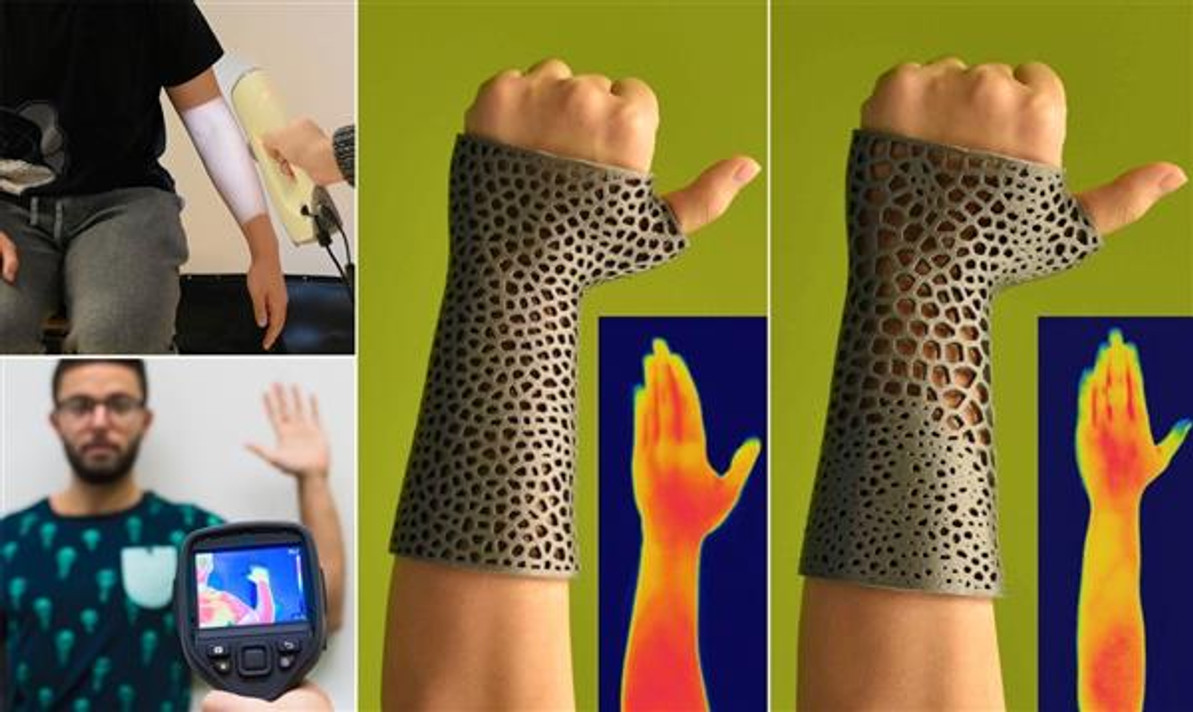 3D printed orthopaedic casts with improved thermal comfort