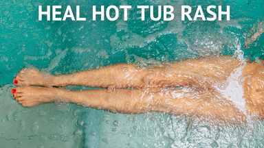 Get Rid of Hot Tub Rash