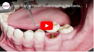 From Start to Finish: Understanding the Dental Implant Process