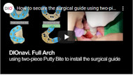 How to secure the surgical guide using two-piece putty bite