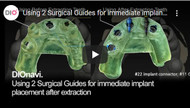 Using 2 Surgical Guides for immediate implant placement after extraction 