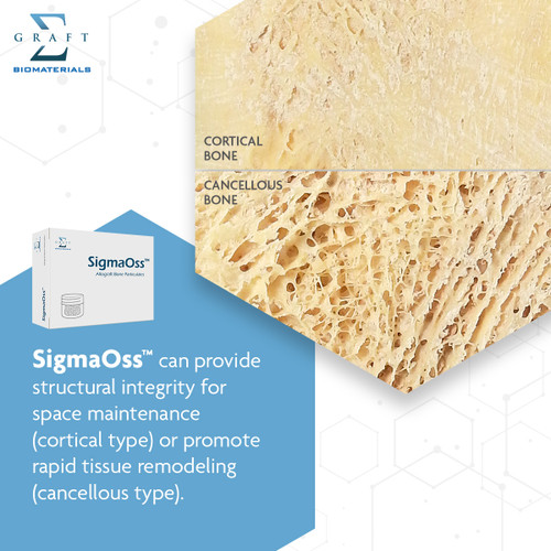 SigmaOss Allograft Bone