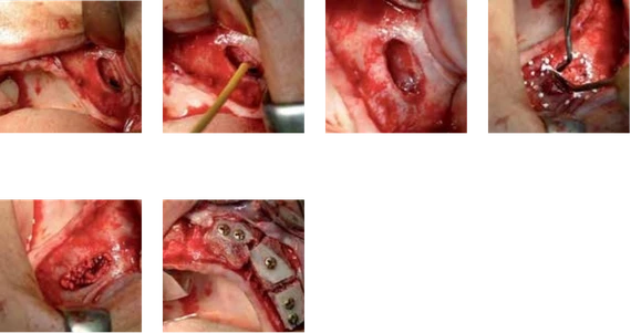 Six manufacturer-provided clinical images illustrating the referenced sinus floor elevation case sequence