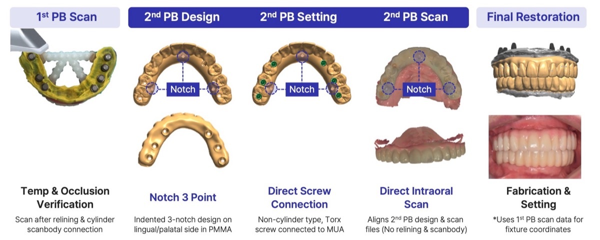 DIO NAVI Full Arch 2-step provisional bridge: notch 3 point, direct screw connection, direct intraoral scan
