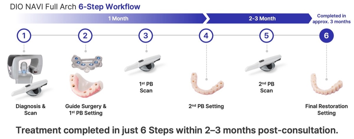 DIO NAVI Full Arch 6-step workflow completed in about 3 months