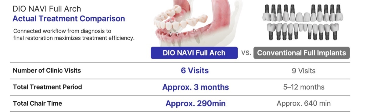 DIO NAVI Full Arch versus conventional full implants: 6 visits, about 3 months, about 290 minutes chair time