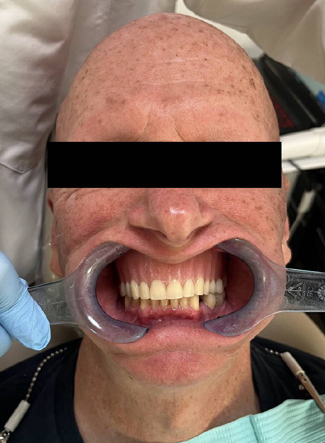 Facial photo example front retract
