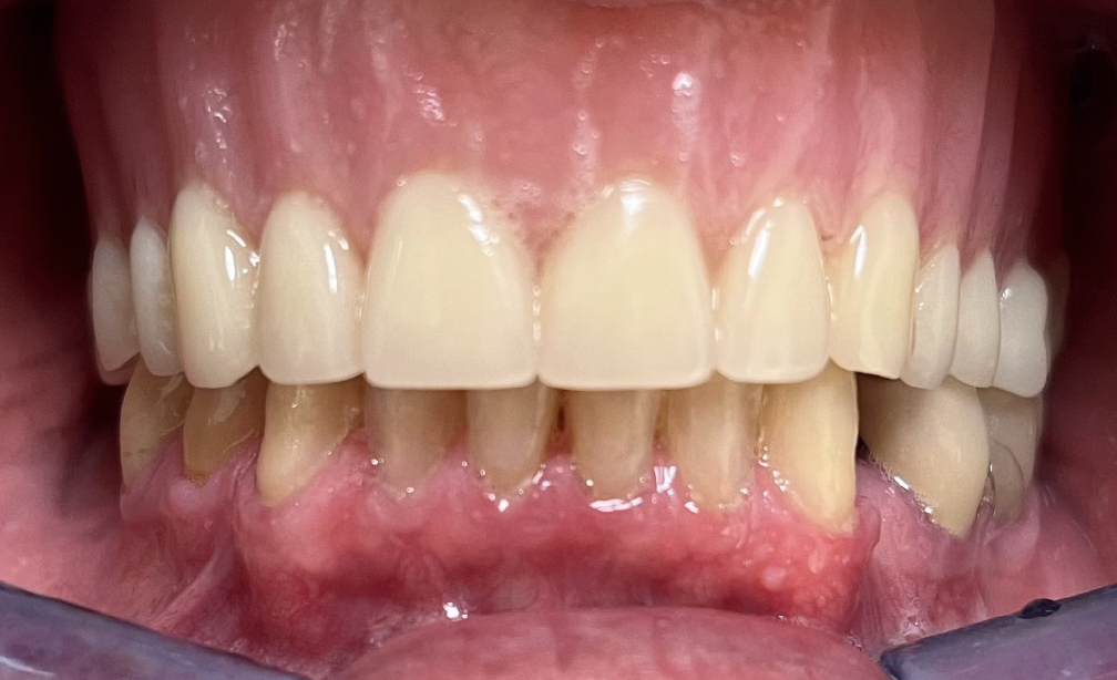 Intraoral front photo example