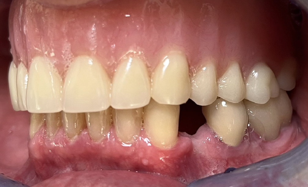 Intraoral second lateral photo example