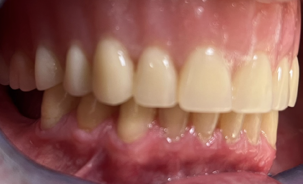 Intraoral lateral photo example