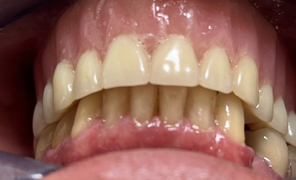 Intraoral overjet photo example