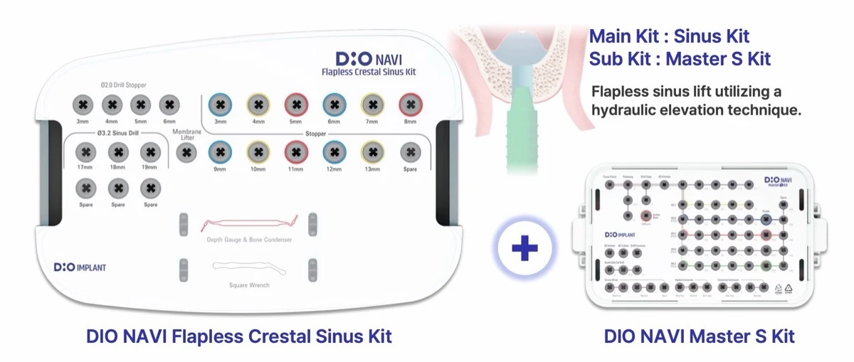 DIO NAVI Flapless Crestal Sinus Kit with the Master kit