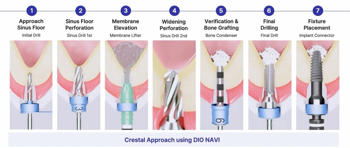 DIO NAVI Flapless Crestal Sinus Kit 7-step protocol