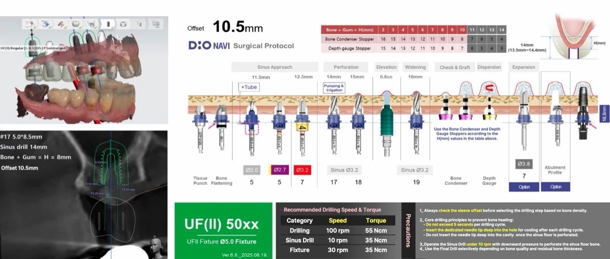 DIO NAVI sinus surgical protocol with offset 10.5 mm, speed and torque