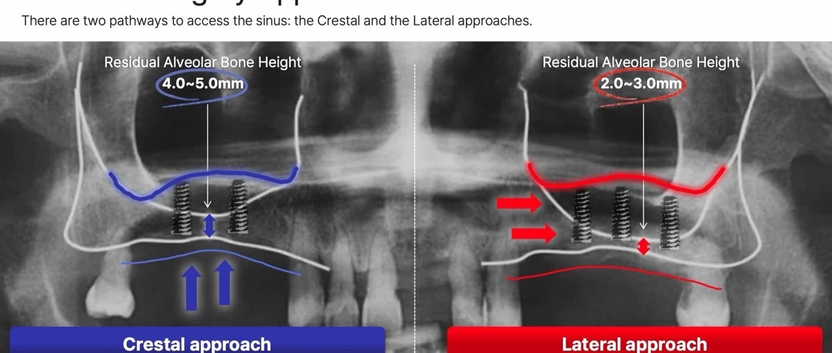 Crestal versus lateral sinus lift approach