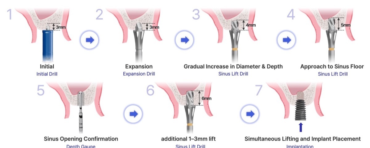 Sinus Drill surgical protocol in 7 steps