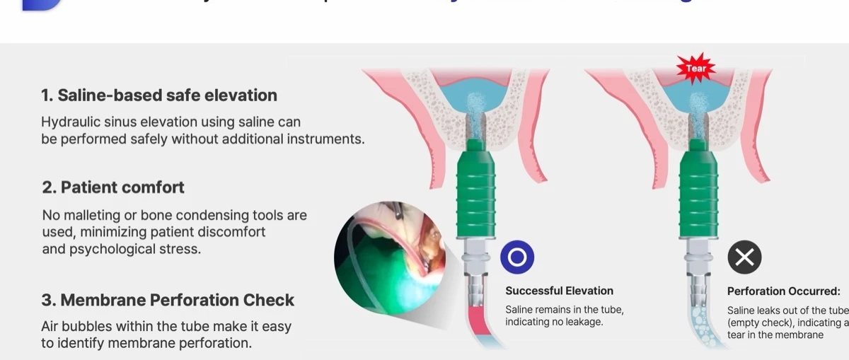 Hydraulic sinus lift advantages and perforation check