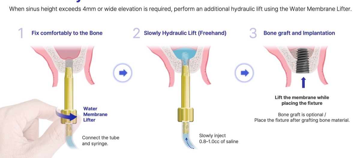 Sinus drill hydraulic lift protocol: slowly inject 0.8 to 1.0 cc of saline