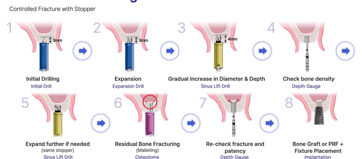 Sinus osteotome surgical protocol