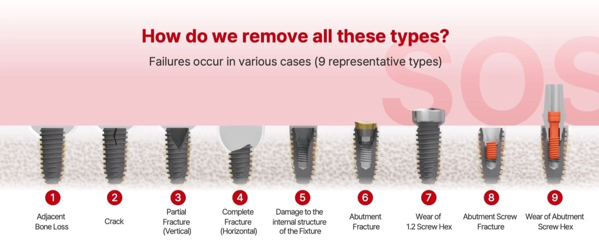 9 representative implant failure types handled by the Dr. SOS+ kit