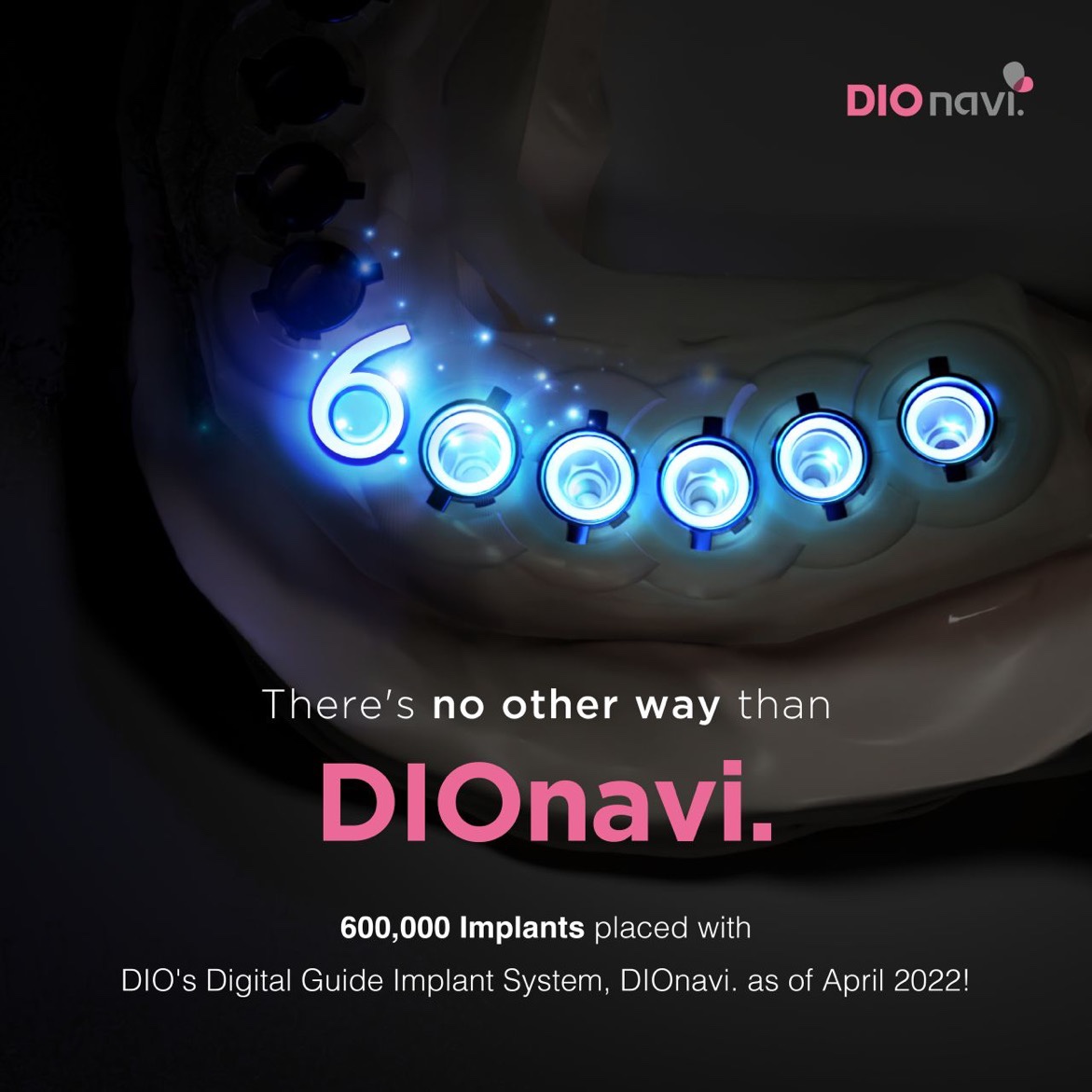 600K implants placed with DIOnavi. Whitecap Dental Solution