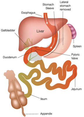 Sleeve Gastrectomy