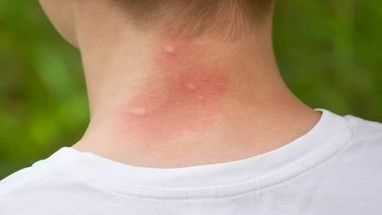 Easing Mosquito Bite Itch Easing Mosquito Bite Itch