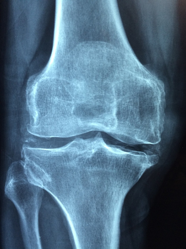 Maca Root and Osteoporosis 