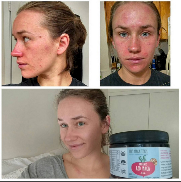 maca acne testimonials - themacateam.com
