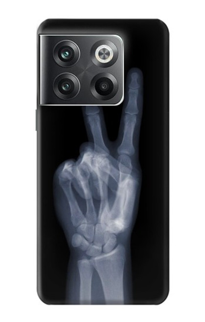 S3101 X-ray doigts Signe de paix Etui Coque Housse pour OnePlus Ace Pro
