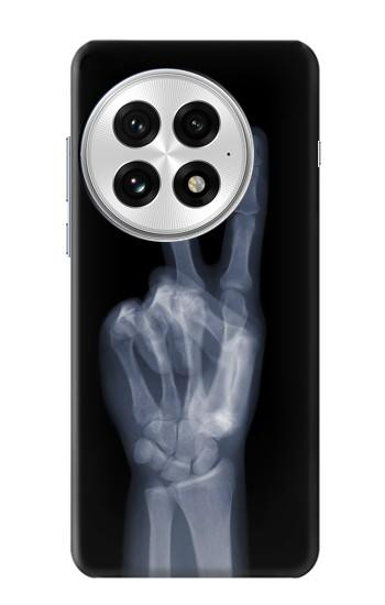 S3101 X-ray doigts Signe de paix Etui Coque Housse pour OnePlus 13