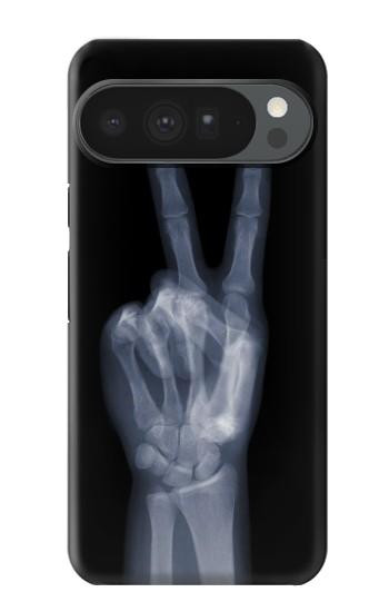 S3101 X-ray doigts Signe de paix Etui Coque Housse pour Google Pixel 10 Pro XL