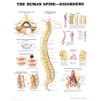 HUMAN SPINE DISORDERS CHART 20" W X 26" H, LAMINATED