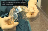 3D printed skull replacement implanted for the first time ever
